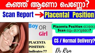 Gender Prediction Malayalam Anterior Placental Boy Girl കുഞ്ഞ് ആണോ പെണ്ണോ [upl. by Lash]