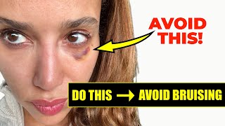 How to Prevent Bruising from Botox and Filler DO THIS Before you get Facial Injections [upl. by Koetke]