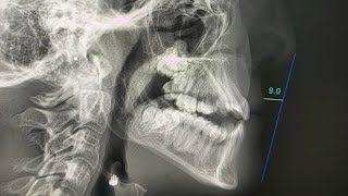 😱😱😱 teeth extracted for orthodontic treatment disaster aligning the teeth destroying the body [upl. by Armalla]