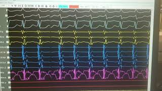 SVT differentiating AVNRT VS AVRT VS ATRIAL TACH [upl. by Franchot]