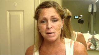 Skin Cancer My Vlog Journal Treatment W EFUDEX vid5 [upl. by Notkcorb]