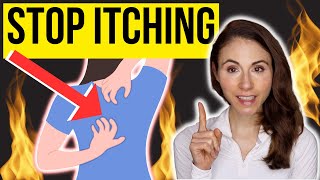 HOW TO STOP ITCHING ON THE BACK  Notalgia Paresthetica [upl. by Sidoeht]