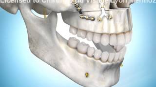 Chirurgie orthognatique sourire gingival traitement [upl. by O'Meara71]