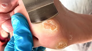 Callus removal from feetampFoot scraping dead skin【Xiao Yan pedicure】stress 617 [upl. by Busey]