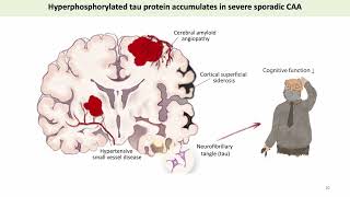 Cerebral Tau Pathology in Cerebral Amyloid Angiopathy [upl. by Kristofor]