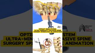 OptiLIF® Endo System  UltraMinimally Invasive Spine Surgery  Spineology  4K Animation 3d short [upl. by Aititil]