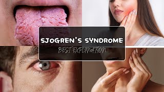 Sjogrens Syndrome Etiology Clinical Features Diagnosis and Treatment [upl. by Notelrac411]