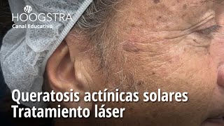 Queratosis actínicas solares  Tratamiento láser  23275 [upl. by Ludovick]