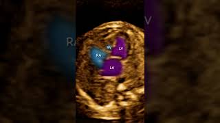 Fetal Ecocardiography Tricuspid atresia plus Ventricular septal defect [upl. by Sairu975]