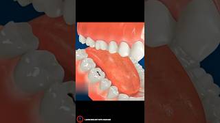 Root Canal Treatment  shorts [upl. by Anerrol]