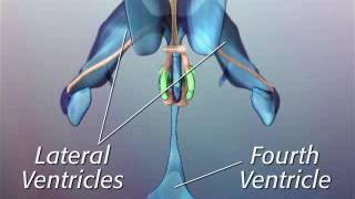 Anatomy of Hypothalamic Hamartoma [upl. by Oznohpla]