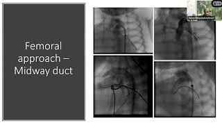 PDA Stenting Tips amp Tricks  Episode 4 [upl. by Cinimmod962]