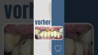 Vorher 😕 Nachher 🦷🙏 shorts zahnarzt dental [upl. by Stefania788]