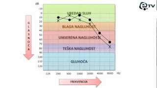 Kako pročitati audiogram [upl. by Malvin921]