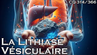 La Lithiase Vésiculaire ou Pierre à la Vésicule  CQ314 [upl. by Ailices744]