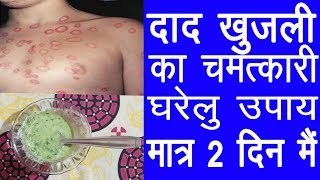 Home Remedies For Ringworm  How To Cure Ringworm In 2 Days [upl. by Alyk667]