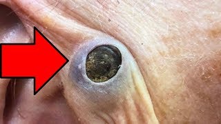 The Largest Dilated Pore of All Time  Pimple Popper [upl. by Herodias]