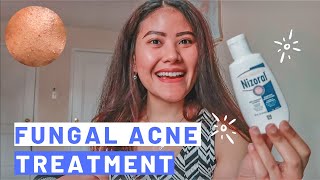 2 WEEKS MALASSEZIA FOLLICULITISFUNGAL ACNE TREATMENT  How to Get Rid of Fungal Acne Fansi Lantana [upl. by Pitts509]