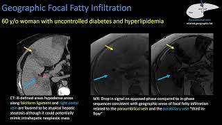 Hepatic Steatosis Part 2 Patterns of Steatosis [upl. by Sibel]