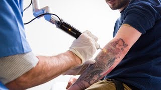 Tattoo Removal Laser Surgery [upl. by Box]