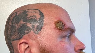 Week 4 Superficial Basal Cell Carcinoma Skin Cancer Aldara Treatment [upl. by Aiouqes675]