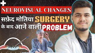 Neurovisual changes after cataract Surgery  Cataract surgery [upl. by Callas687]