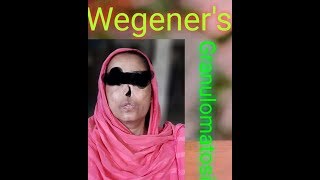 Wegeners Granulomatosis WG Clinical Case Presentation [upl. by Gwendolen457]