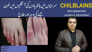 Chilblains Inflammation Sardion mean Hathon Paon ki Unglion Mean Ratt Jamnachilblains [upl. by Nosam]