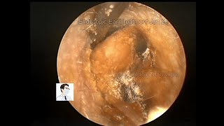 ear wax removing Severe cerumen embolism prosessing [upl. by Ramad]