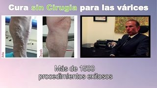 Cura para venas varices SIN CIRUGIA en Bogota Colombia  Tratamiento Ulceras varicosas Linfedema [upl. by Ellehcyt]