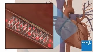 How coronary angioplasty is carried out  Bupa Health [upl. by Quarta929]