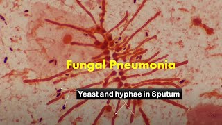 Heavy load of fungus in Sputum Microscopy [upl. by Orgell317]