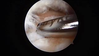 Posterior Ankle Arthroscopy Debridement of Os Trigonum Removal SFISM [upl. by Ecirtnom]