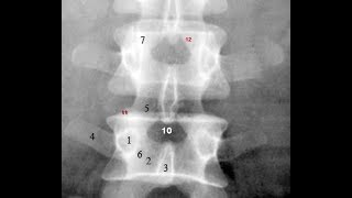 Radiological Anatomy of the Lumbar Spine Xray MRI amp CT Covered [upl. by Liag]