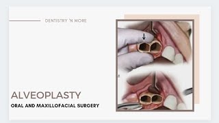 ALVEOLOPLASTY  DEANS ALVEOLOPLASTY  OBWEGESERS ALVEOLOPLASTY  ALVEOLECTOMY [upl. by Ecirehc]