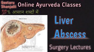 Liver abscess by Geetaru [upl. by Haughay]