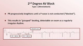 Intro to EKG Interpretation  AV Block [upl. by Jos]