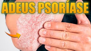 SE VOCÊ TEM PSORÍASE ALERGIAS DE PELE COCEIRAS E ESTRIAS ESSA ERVA MEDICINAL PODE MUDAR SUA VIDA [upl. by Sillaw]