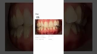 INSANE clear aligner TRANSFORMATION with Bitesoft clearaligners dentist dentalaligners [upl. by Eliott547]