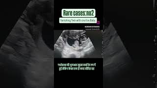 A case of vanishing Twin where the pregnancy started as twin but one baby miscarriedvanishingtwin [upl. by Diane573]