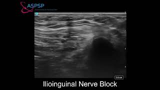 Ultrasound Guided Ilioinguinal nerve block [upl. by Yauqram804]