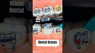 Orthodontics Brackets Braces [upl. by Erund]