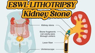 Operation of Lithotripsy  ESWL Lithotripsy  Kidney Stone Treatment  Renal DJ Stent [upl. by Resay]