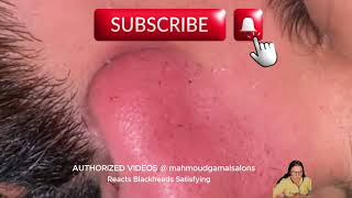 blackheads nose tweezers blackheads nose strips blackheads nose removal satisfying [upl. by Miyasawa544]