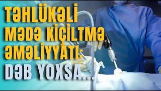 Təhlükəli mədəkiçiltmə əməliyyatı dəb yoxsa [upl. by Aksehcnarf]