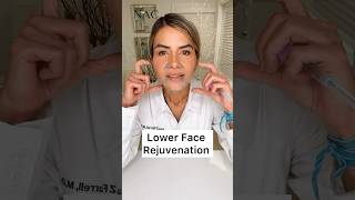 Lower Face Rejuvenation drbitafarrell botox fillers [upl. by Alicsirp301]