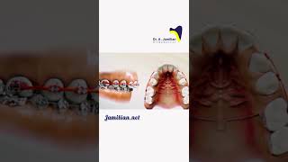 Upper Jaw Extraction for Incisor Retraction dentist extraction orthodontics retraction brace [upl. by Oberstone]