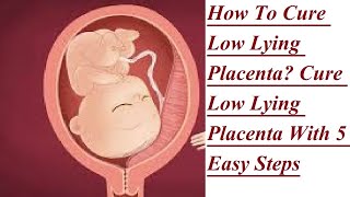 All about low lying placenta l low lying placenta ka treatment [upl. by Ethelyn]