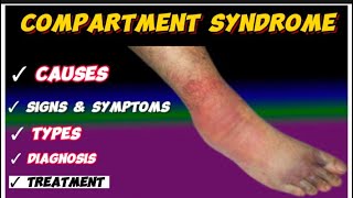 compartment syndrome [upl. by Neelyaj]