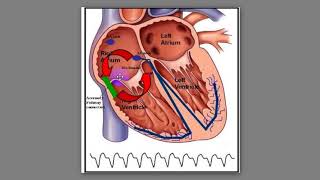 72 Phân biệt cơn AVNRT và Orthodromic AVRT [upl. by Bower809]